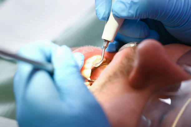 Best Emergency Wisdom Teeth Removal in Shady Cove, OR